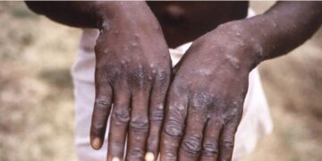 Variole du singe: l’unique cas confirmé en Guinée est guéri (ANSS)